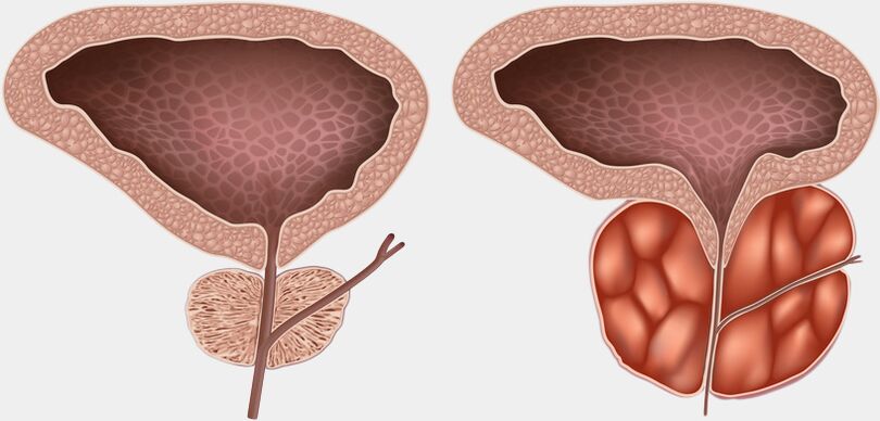 prostate